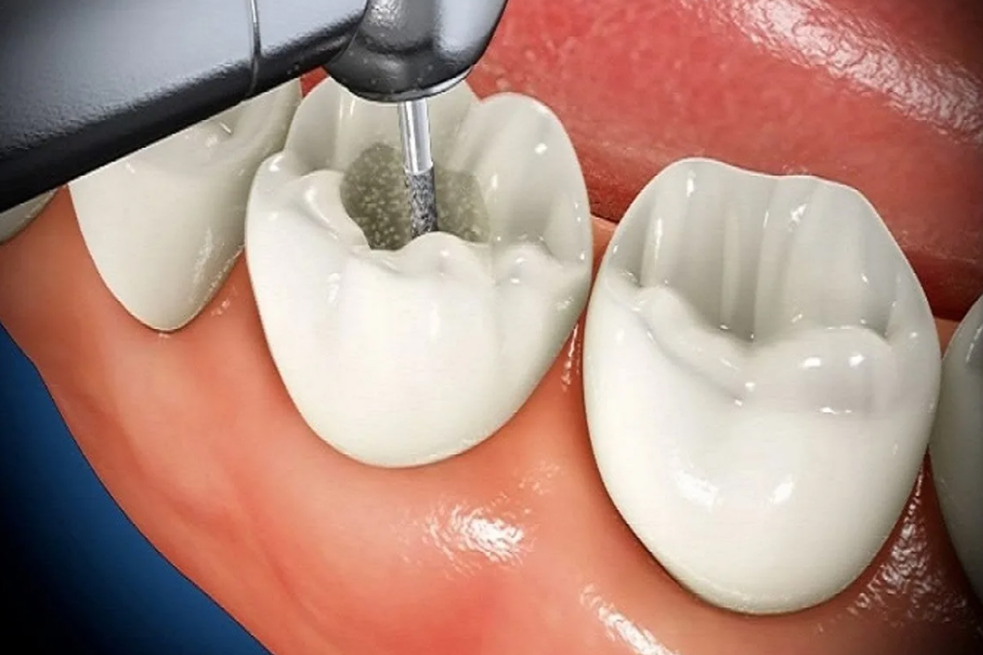 Darıca Diş Polikliniği Endodonti Tedavisi